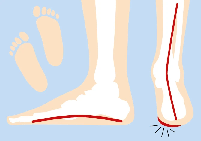 flat feet